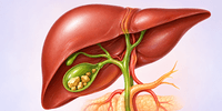 Gallbladder Stone