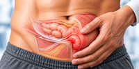Hernia Surgery